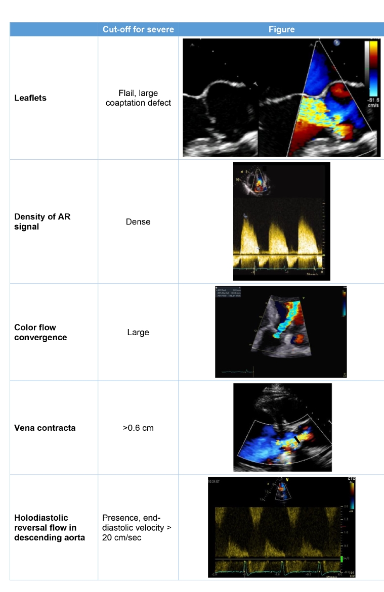 The Value Of Echocardiography In Aortic Valve Disease: The Essentials